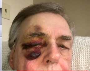 Photo of Gooding's Injuries From Another Angle