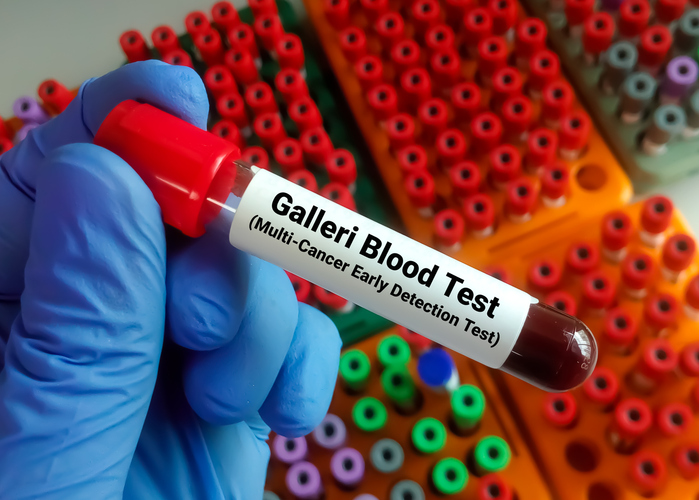 Researcher holding blood sample tube for Galleri blood test for the early diagnosis of multi-cancer (more than 50 types of cancer).
