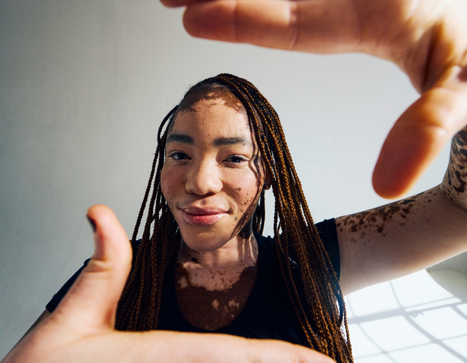 Gen Z woman with vitiligo embracing her unique skin. Beauty and wellness concept.