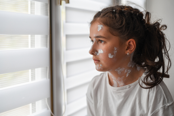 A sad little girl with a red rash on her skin is looking out the window. She has chicken pox and measles on her face.