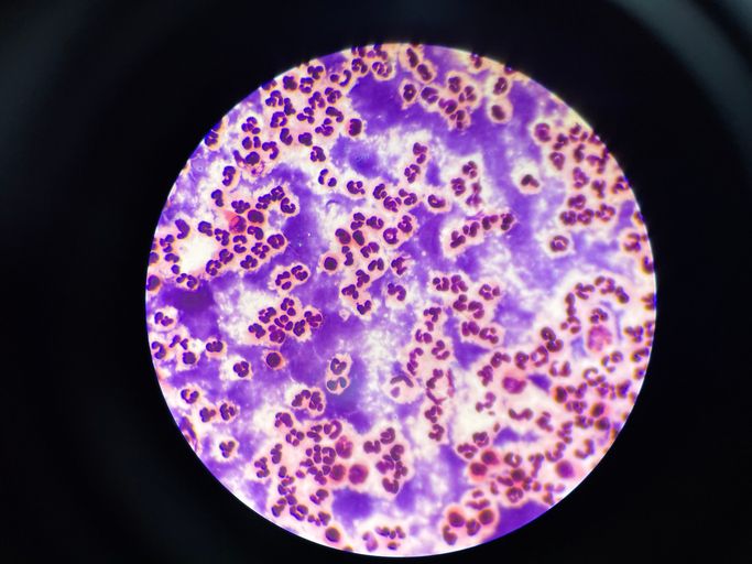 Officials blame higher rates of cancer on people not getting their checkups during the pandemic