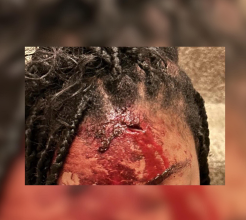 Close-up of a person's head with braided hair and a visible injury on the forehead, with blood and swelling.