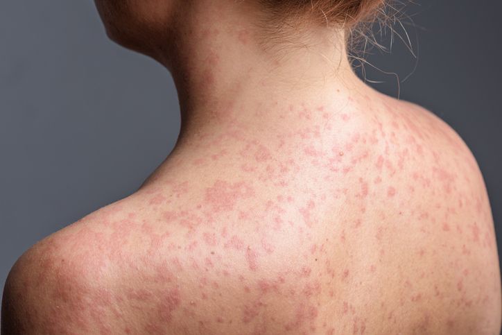 A woman with a red, spotty rash caused by measles.